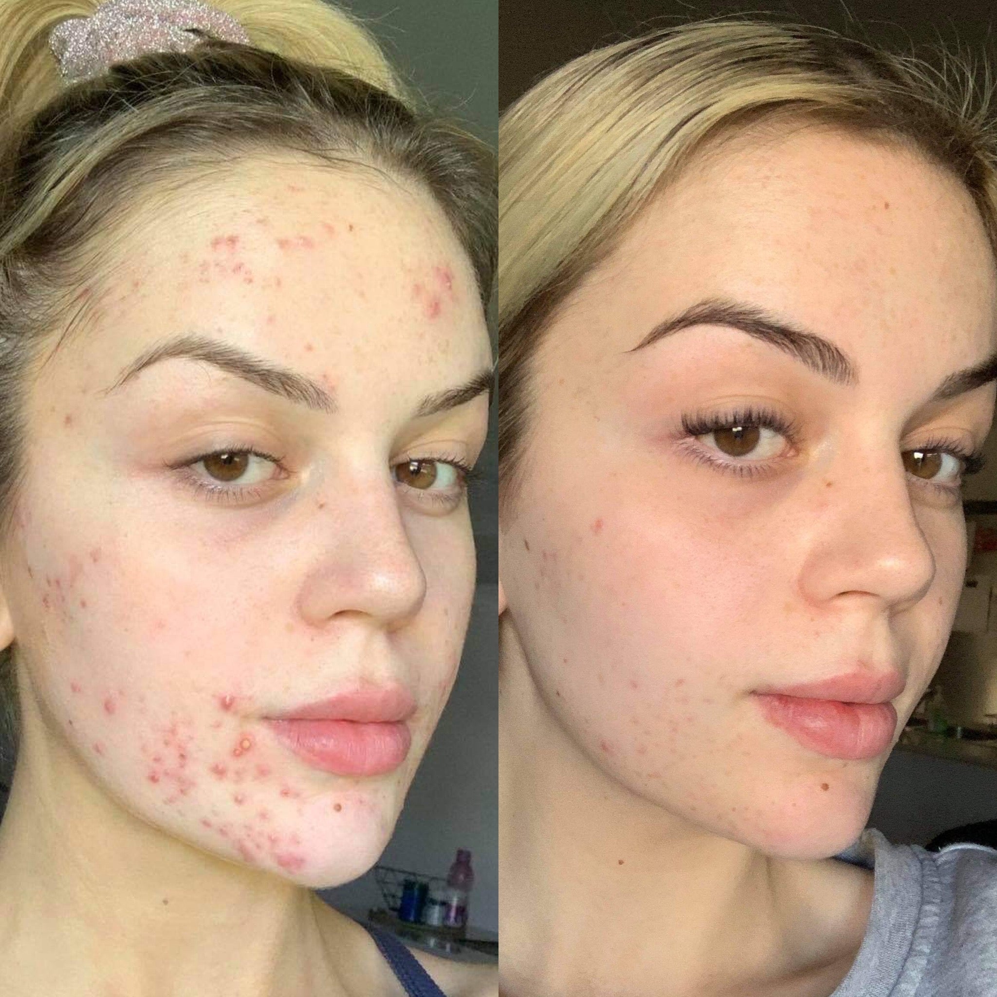 Transformations – Skin Love Clinic