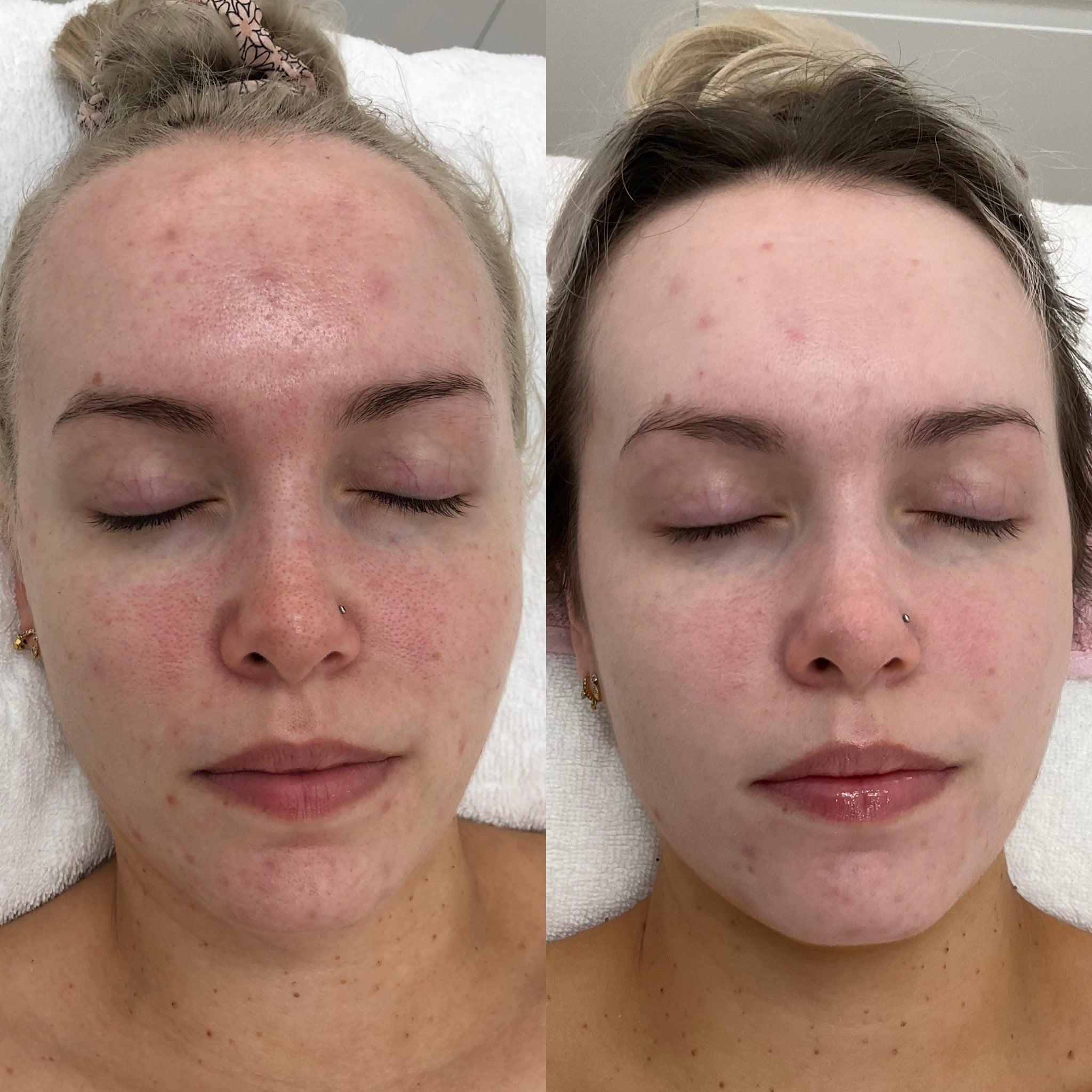 Transformations – Skin Love Clinic