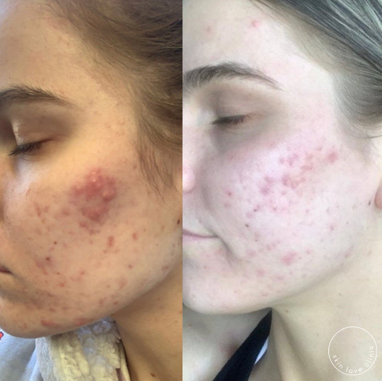 Transformations – Skin Love Clinic